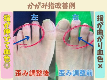 ニコ(niko)/かがみ指改善例