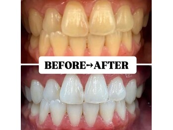 ホワイトニングサロン 宝塚/Before&After美白ホワイトニング