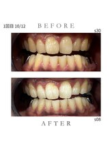 エンルーチェ プラスエイト(en;Luce+8)/ホワイトニング　1回