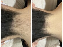 エリクサー 加須店(Elixir)/うなじ脱毛は隠れ人気！