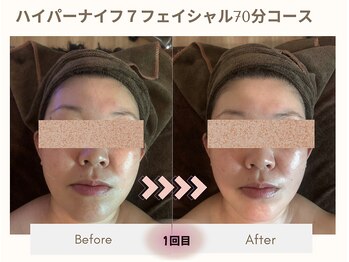 漢方アロマヒーリングサロン 浦和店(漢方AROMAヒーリングサロン)/ハイパーナイフ7フェイシャル