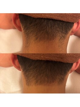 アル(ARU)/メンズ脱毛