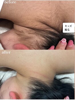 インク(ink)/キッズ脱毛