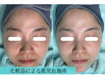 リメイクビューティークリニック(REMAKE BEAUTY CLINIC)/合わない化粧品での肌荒れにも