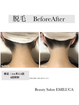 エミルカ(EMILUCA)/うなじ脱毛