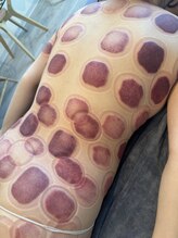 ビレイ(Birei)/カッピング