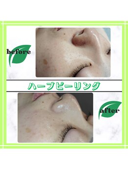 グランディールアン(GRANDIR UN)/ハーブピーリング