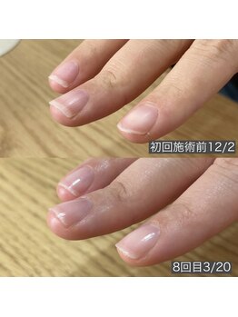 自爪育成ネイルケア