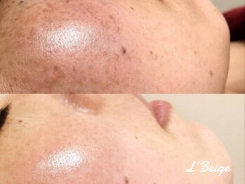 レ ベージュ(L’Beige)/リアボーテ肌質改善フェイシャル