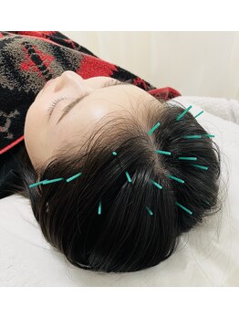 佐藤鍼灸院 美顔鍼プレム(美顔鍼PUREMU)/ヘッドケア(頭皮の施術2)