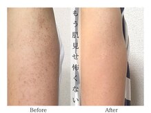 リララ(lelala)/ビフォーアフター☆