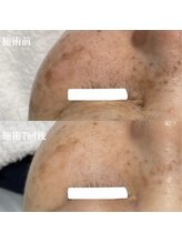 サロンドベルム(Salon de BELME)/シミケア経過：施術7回後