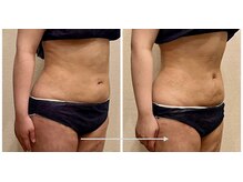 サロン タエンの雰囲気（ウエストの施術後ケアです。むくみと硬さにアプローチしました。）