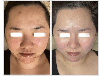 美しぐれ 溝の口/【1年】LDM/ピーリング/プラズマ