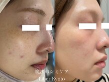 エステティック リベル キョウト 京都駅前店(Esthetic Liber Kyoto)/魔法のシミケア
