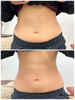 スナオダイエット(SunaoDiet)/くびれ腸もみビフォーアフター