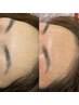 【生え際まで美しく☆】美眉Waxing +額の産毛脱毛セット