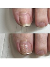 リリ(lili)/巻き爪矯正1回目（左親指）