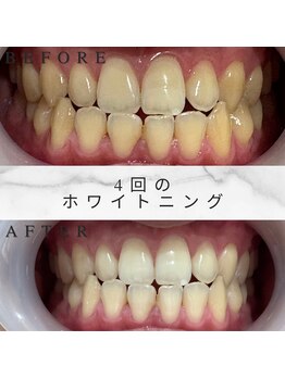 ホワイトスマイル(White Smile)/【ビフォーアフター】４回施術