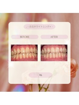 プラスビー 2号店(+b)/ホワイトニングビフォーアフター