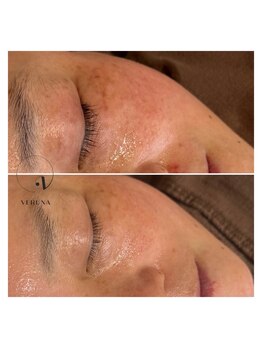 アトワ(A toi)/ハーブピーリング(棘あり)