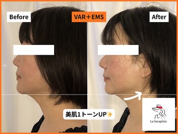 ラ セラフィータ 中目黒/美医レベルフェイシャル★VAR