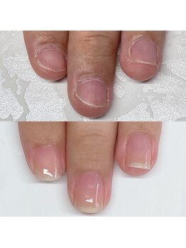 自爪矯正/地爪矯正/二枚爪/深爪