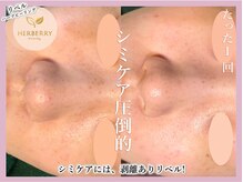 ハーバリー ハーブピーリング 大阪梅田店(HERBERRYハーブピーリング)/梅田ハーブピーリングHERBERRY