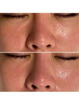 レアリゼ(Realiser)/1回のビフォーアフターです♪