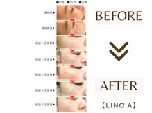 リノア 柏(Lino'a)/ポイントシミケア｜部分シミケア