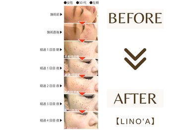 リノア 柏(Lino'a)/ポイントシミケア｜部分シミケア