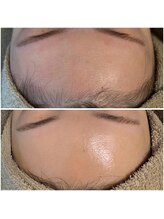 ゆでたまご/ラミピールbefore→after