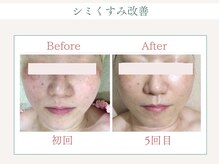 トータルビューティー ゆみえエステ(Total Beauty)/リベルハーブピーリング