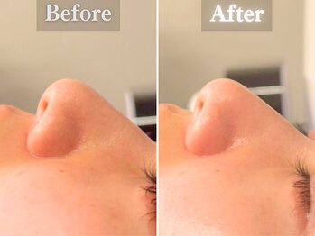 ボーンオム(Born Homme)/毛穴洗浄＋美容液導入：20代女性