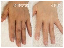 キレイテ 福岡天神店/40代/6回目【大名ハンドケア】