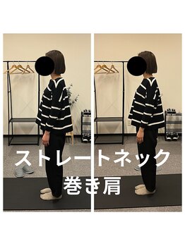 熊本カワル整体 JR上熊本駅院/ストレートネック・巻き肩