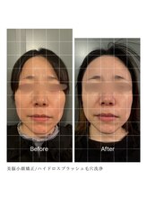 ルフレ 心斎橋(Reflet)/小顔矯正&毛穴洗浄　BeforeAfter