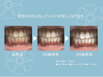ホワイトニング ハナ 南本町店(WHITENING HANA)/お好みの白さへ！