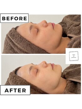 サロン ド パーフェクション(Salon de Perfection)/小顔リフト