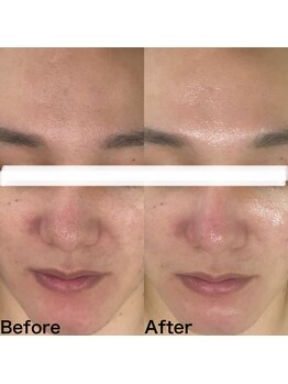 マスカレード 品川(Masquerade)/【症例写真】施術1回