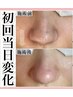 【毛穴×角質除去】AHAピーリング＋ハイドラ水素毛穴洗浄 60分