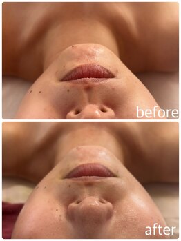 サロン ド リー(Salon de Re)/一回でもニキビ鎮静♪