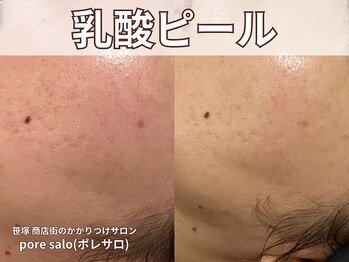ポレ サロ(pore salo)/【乳酸ピール｜毛穴｜赤み】