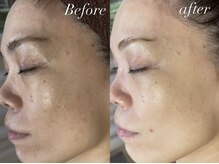 レシェルサロン(Lechelle Salon)/ハーブピーリング＋オプション