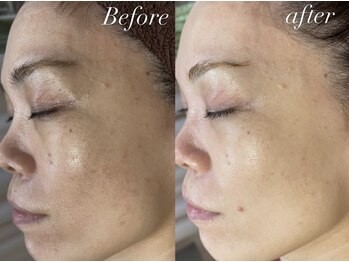 レシェルサロン(Lechelle Salon)/ハーブピーリング＋オプション