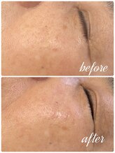 ミアローザ(Mia Rosa)/光フェイシャル☆シミケア