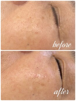 ミアローザ(Mia Rosa)/光フェイシャル☆シミケア