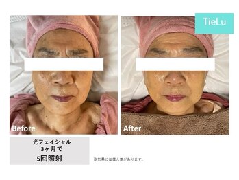 ティエル(TieLu)/光フェイシャル