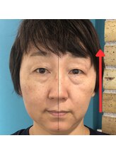 ネクスフィット(Nexfit)/小顔矯正フェイスリフトの効果