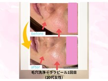 クローバー(clover)/毛穴洗浄+ララピール♪もてツヤ